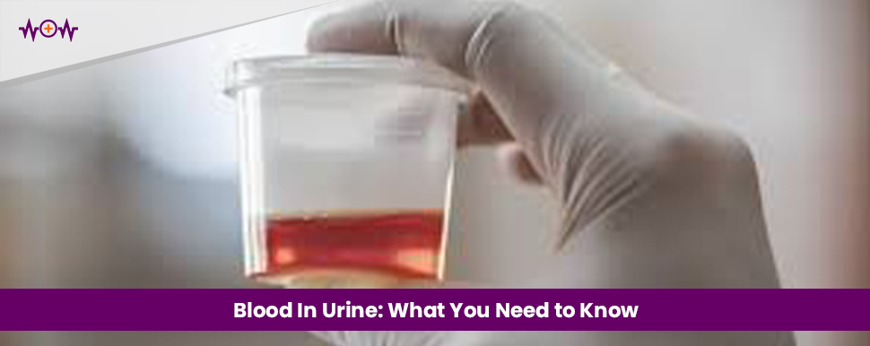 Blood In Urine: What You Need to Know