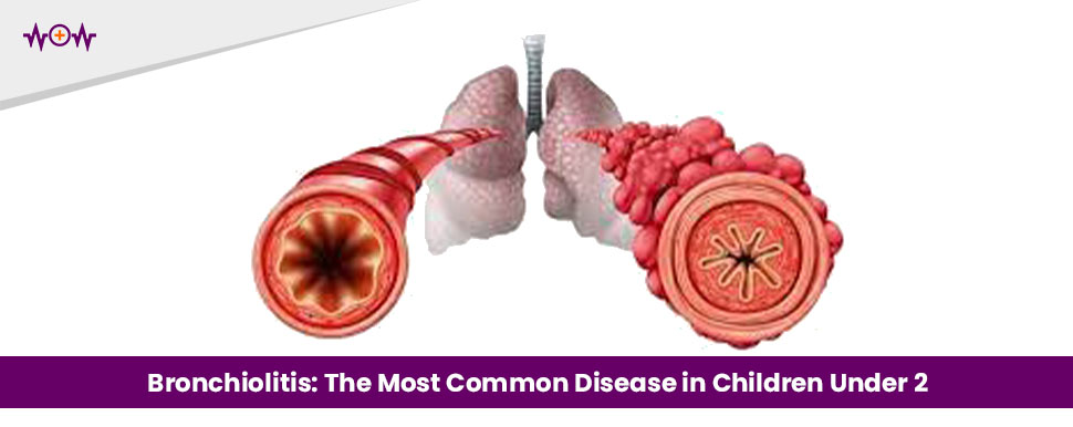 Bronchiolitis: The Most Common Disease in Children Under 2