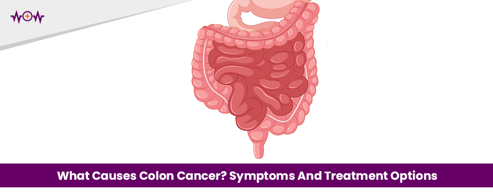 what-causes-colon-cancer-symptoms-and-treatment-options