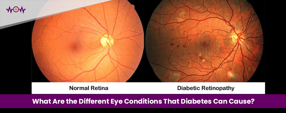 What Are the Different Eye Conditions That Diabetes Can Cause?