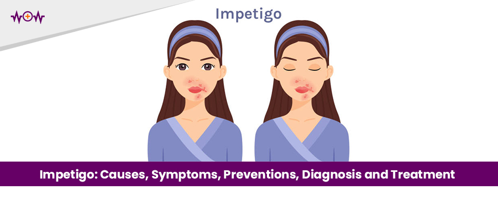 Impetigo: Causes, Symptoms, Preventions, Diagnosis and Treatment
