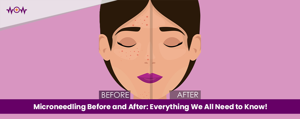 Microneedling Before and After: Everything We All Need to Know!