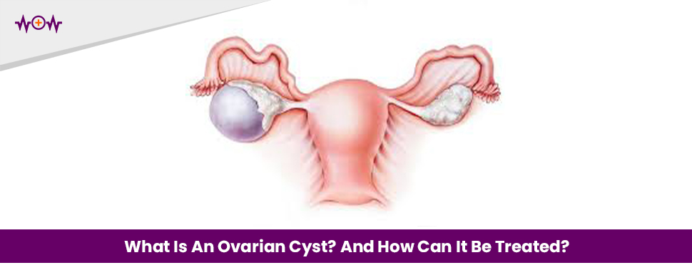 What Is An Ovarian Cyst? And How Can It Be Treated?