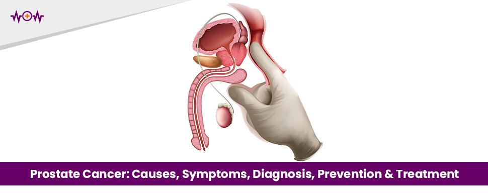 Prostate Cancer: Causes, Symptoms, Diagnosis, Prevention & Treatment