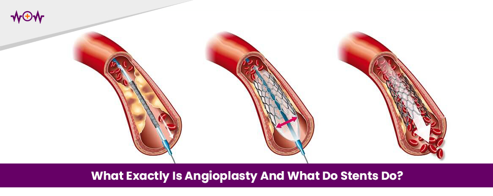 What Exactly Is Angioplasty And What Do Stents Do?