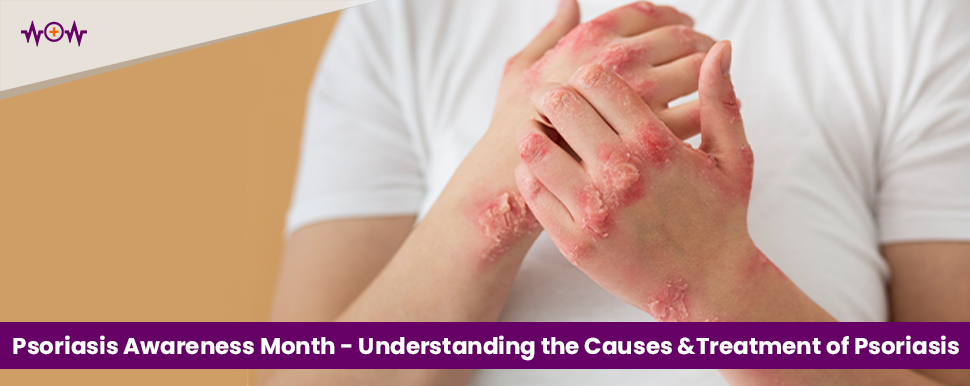 Psoriasis Awareness Month – Understanding the Causes and Treatment of Psoriasis