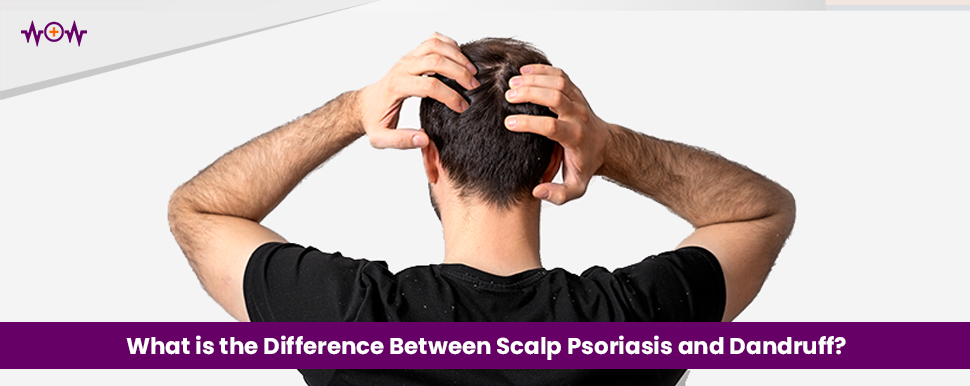 What is the Difference Between Scalp Psoriasis and Dandruff?