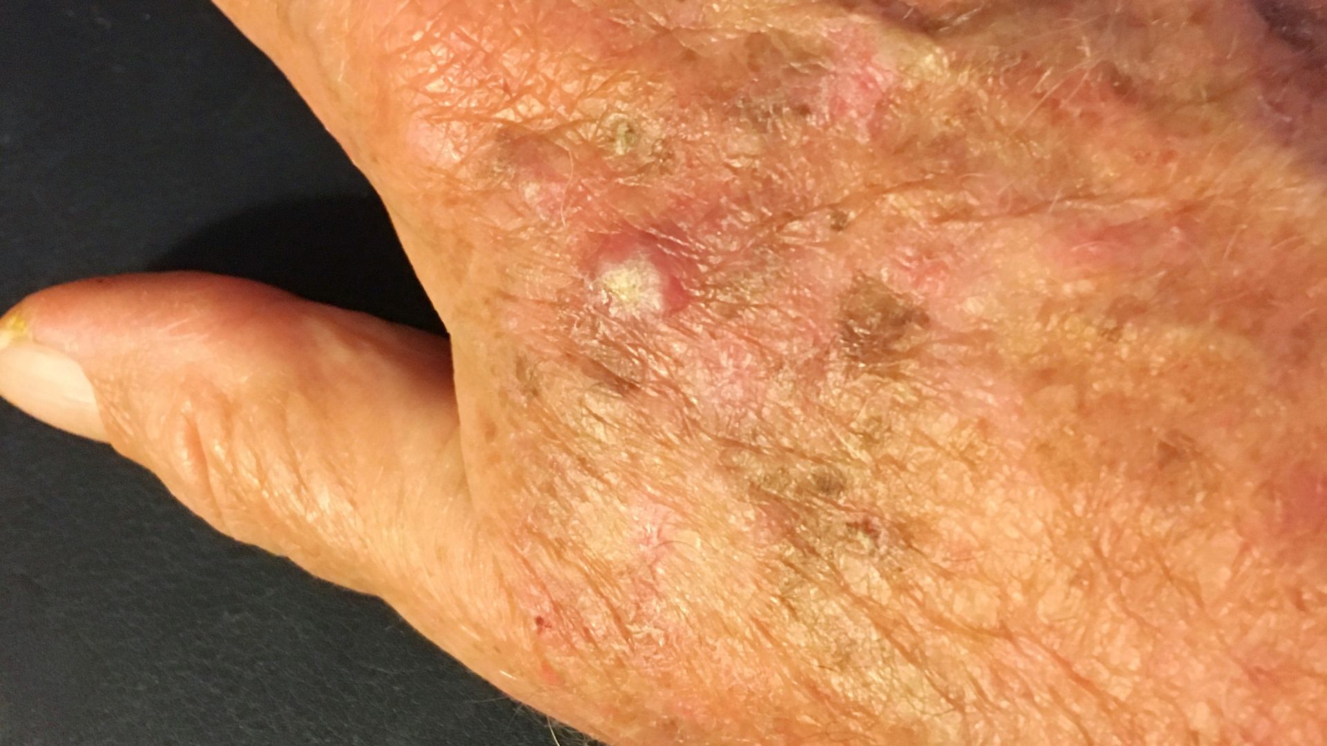 Actinic Keratosis