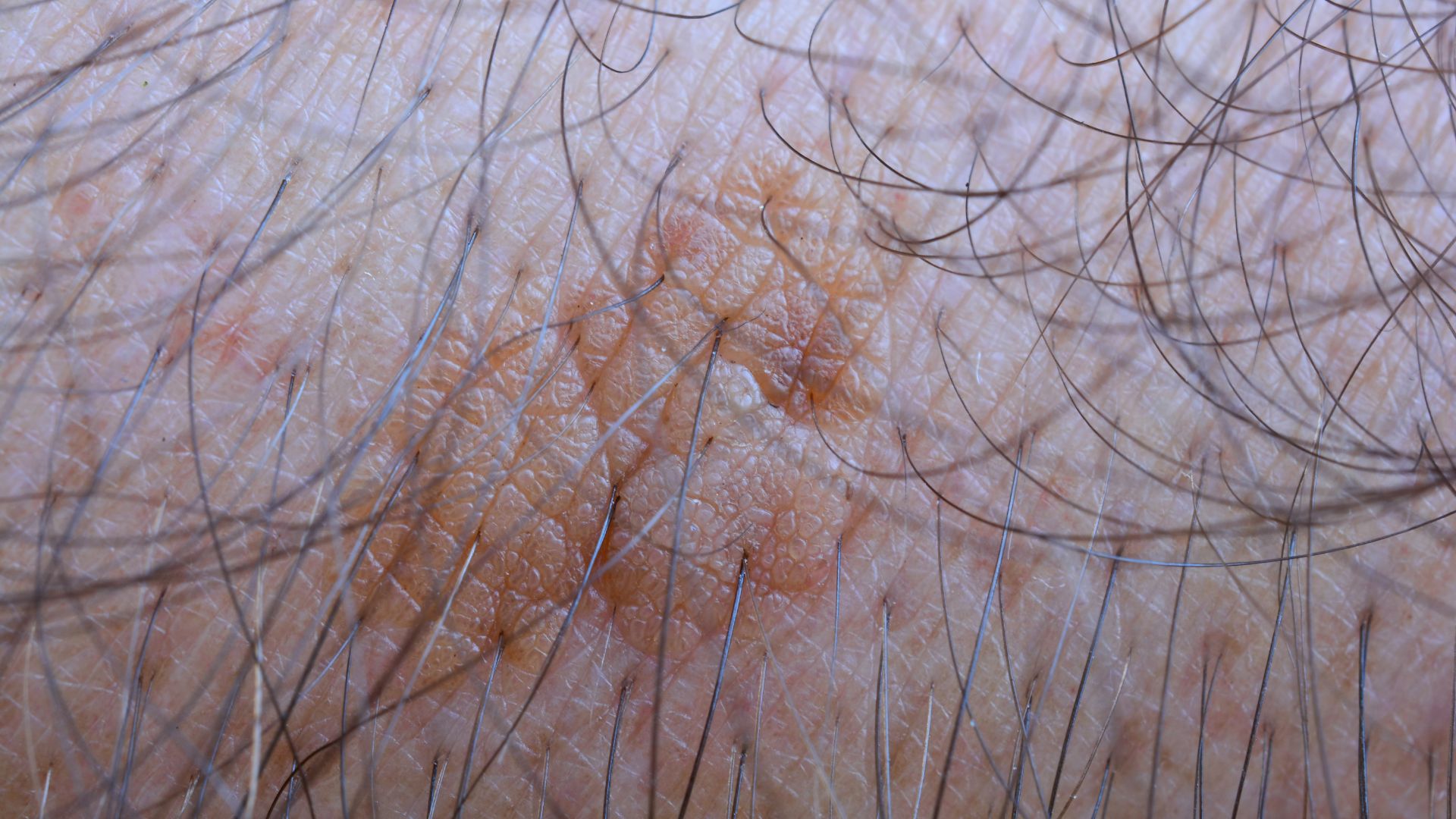 Actinic Keratosis