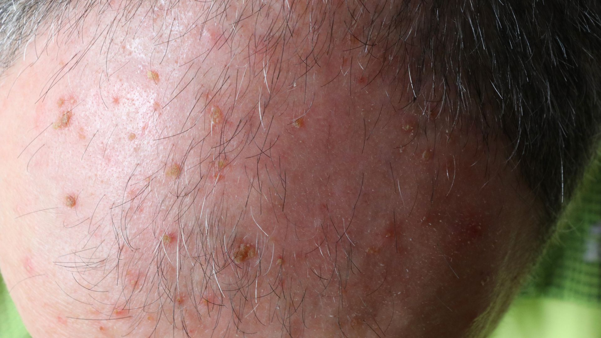 Actinic Keratosis