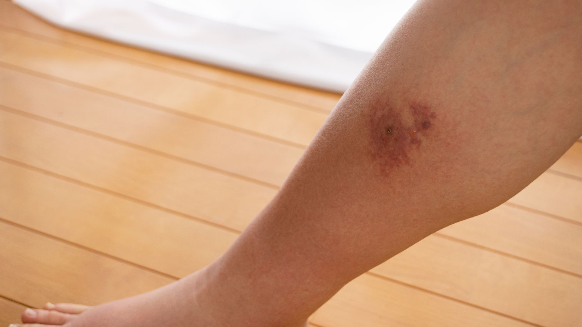 All You Need to Know about Cellulitis