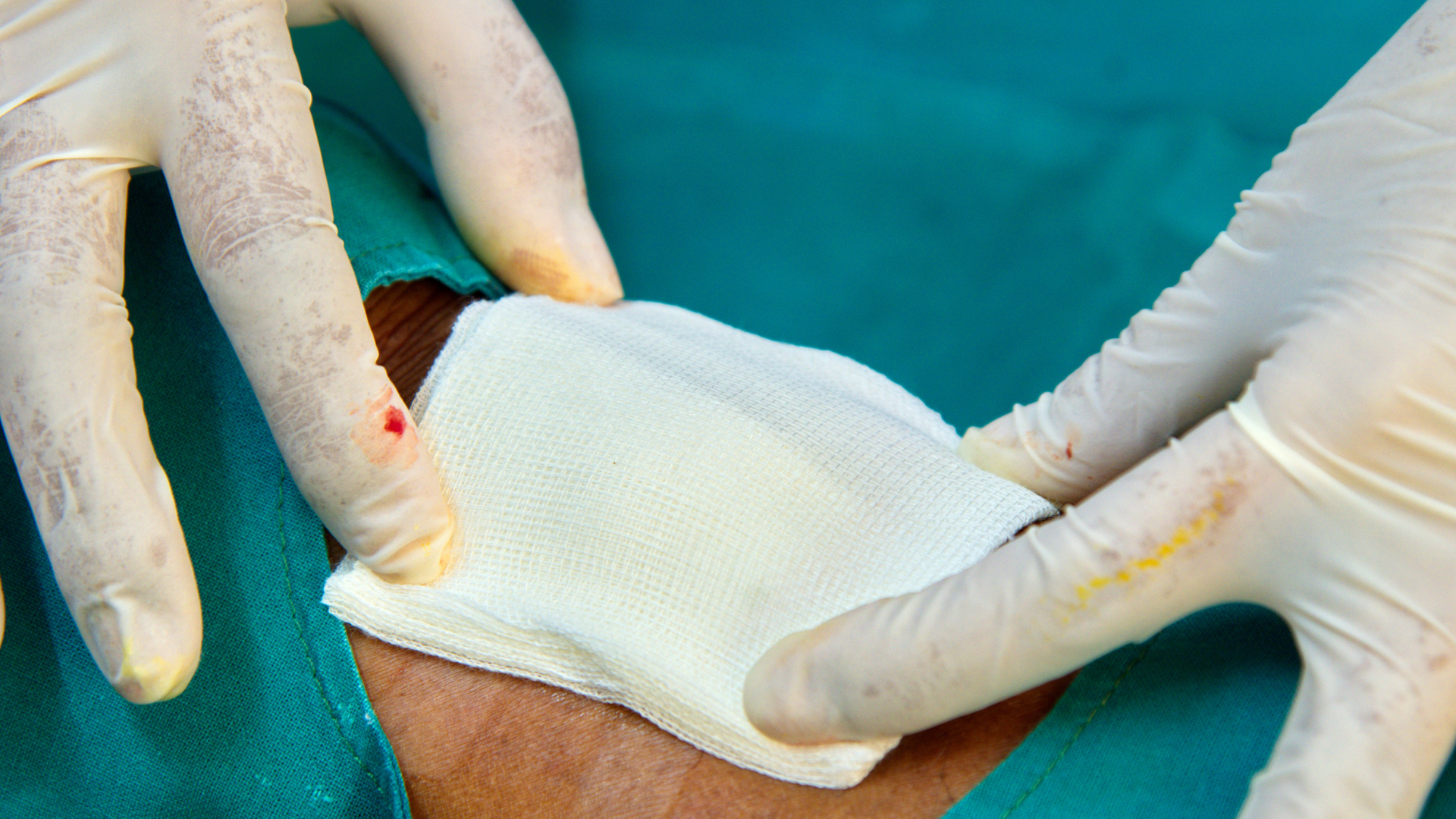 antiseptics for open wounds