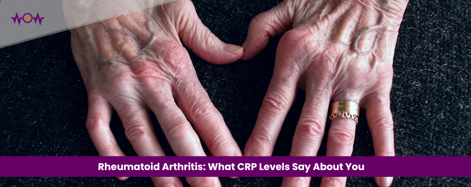 Rheumatoid Arthritis: What CRP Levels Say About You