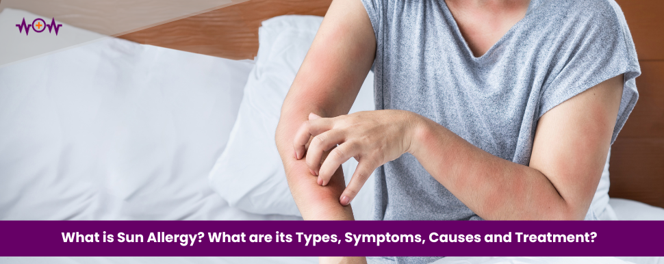 What is Sun Allergy? What are its Types, Symptoms, Causes and Treatment?